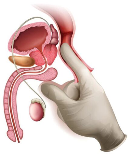 Prostate diseases